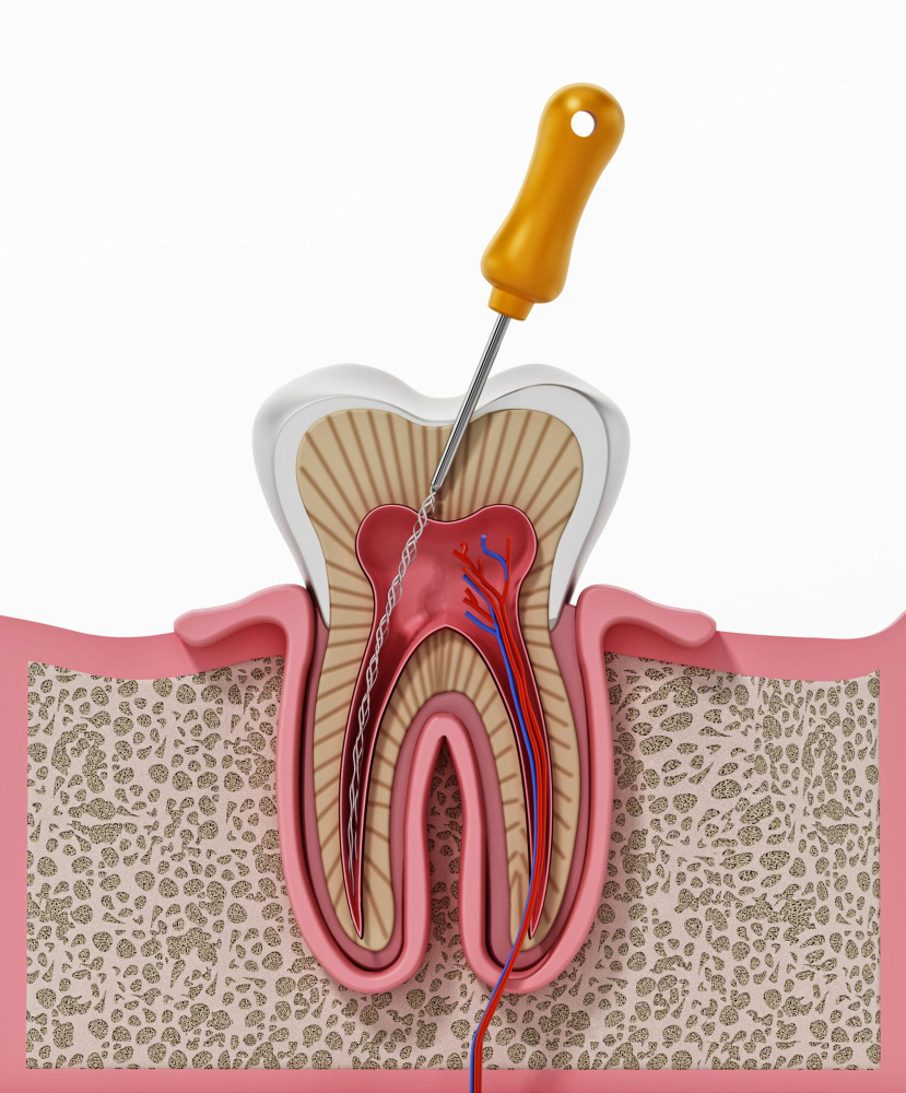 3d-illustration-root-canal-treatment-process.jpg