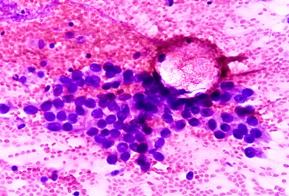 adenocarcinoma-lung-type-non-small-cell-carcinoma-fnac-1686569639.jpg