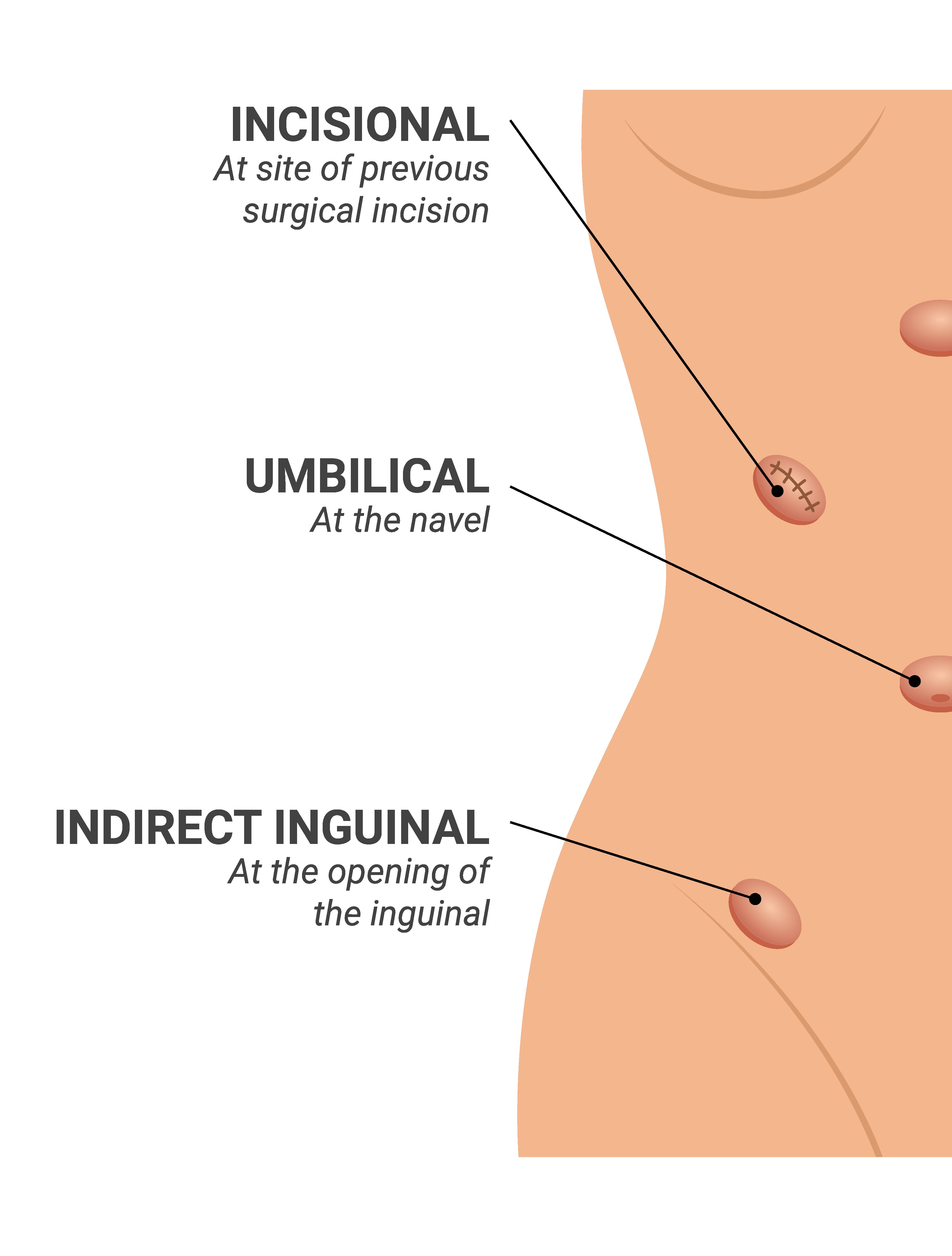 types_of_abdominal_hernias_illustration_on_isolated_background.jpg